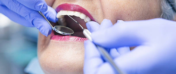 Best Emergency Wisdom Tooth Extraction in Mission Bend, TX